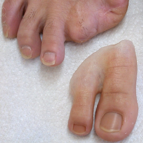 Prótese Parcial de pé em silicone - amputação 1º e 2º pododáctilos